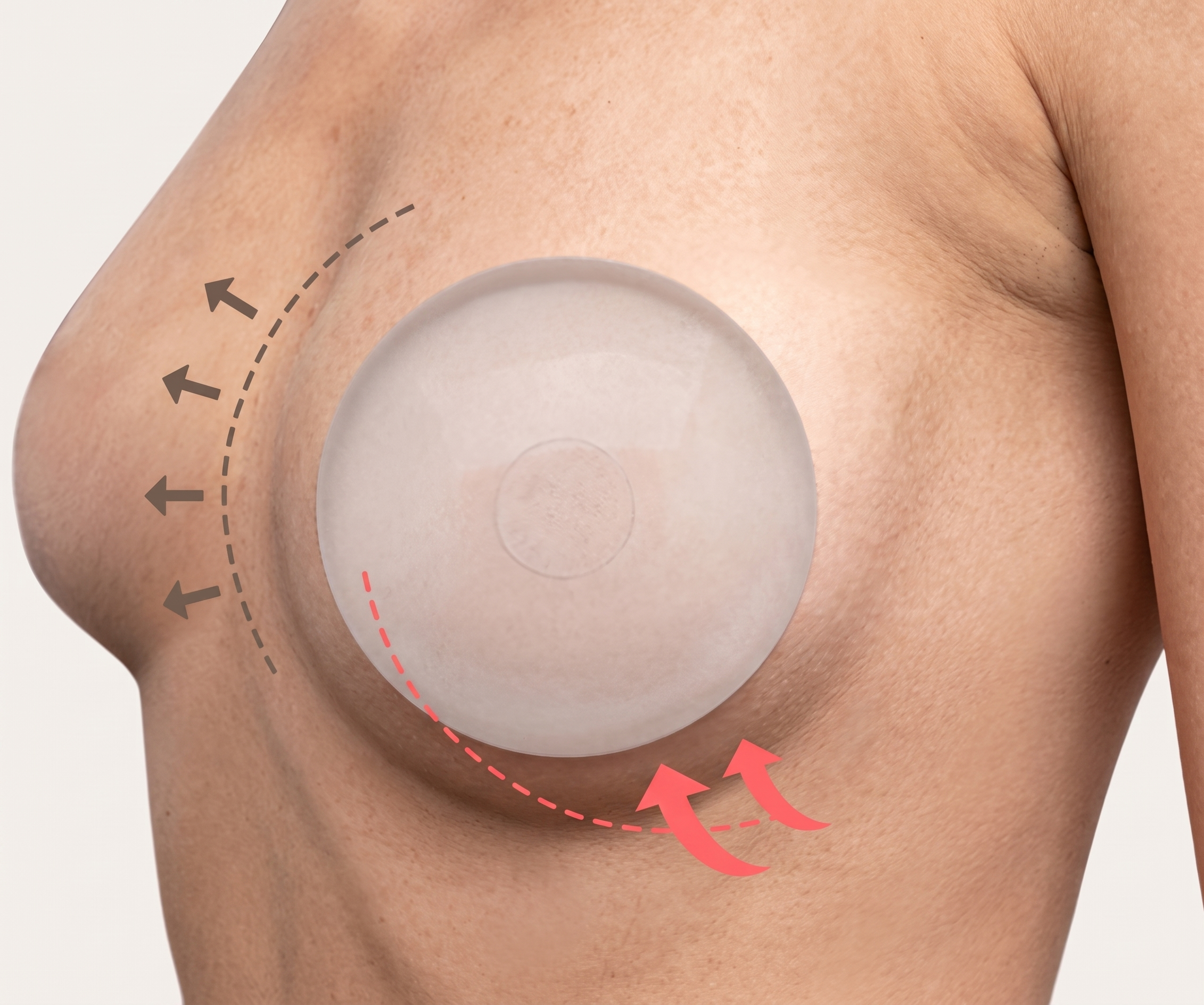 バストリフト（乳房懸垂術） — illustration