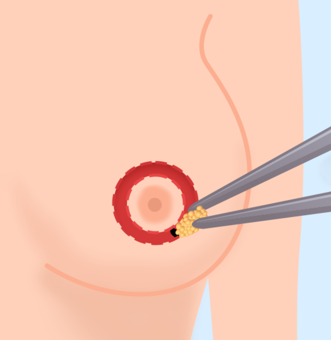 乳房縮小手術 — illustration