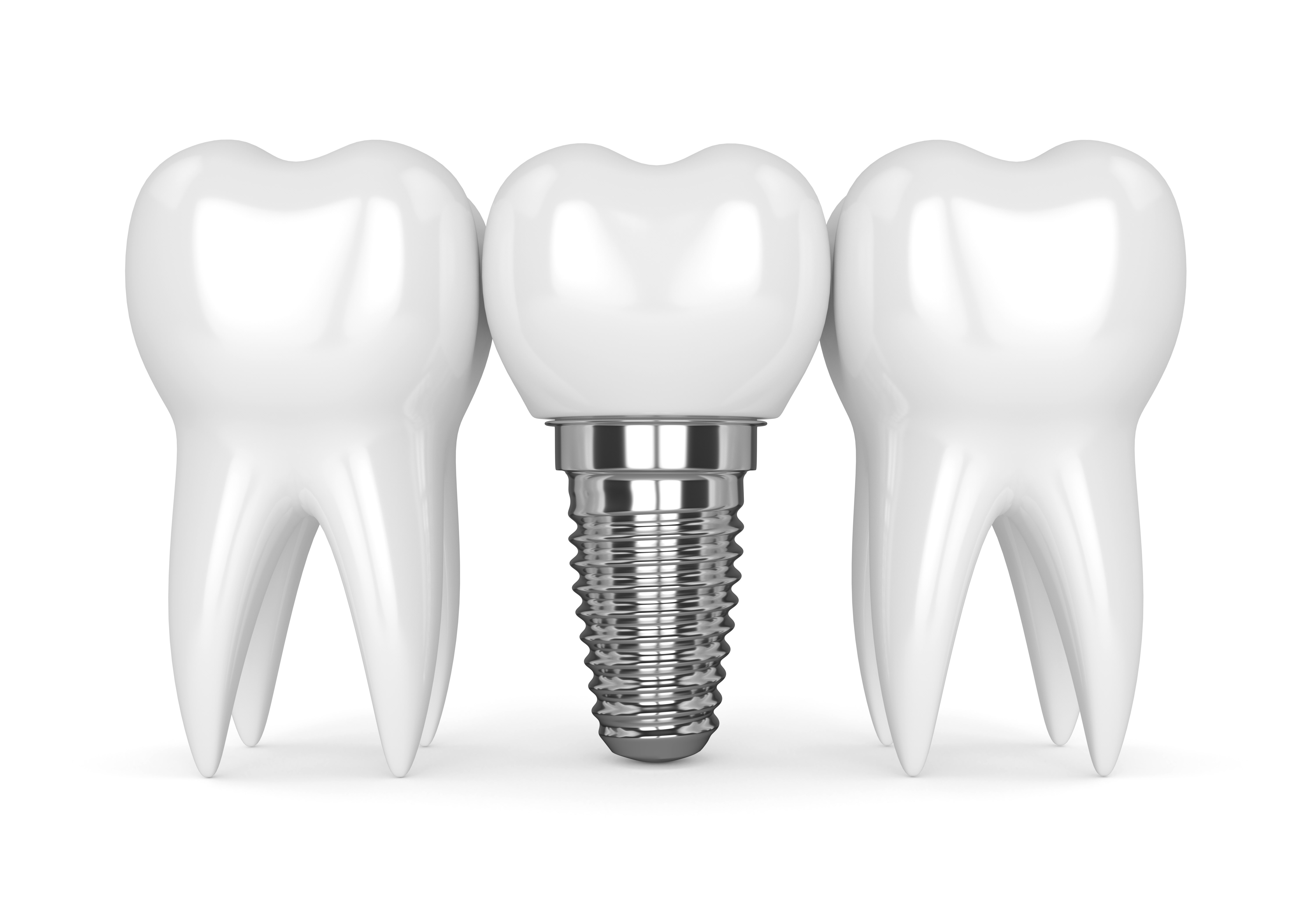 インプラント — illustration